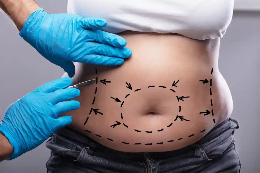 Fat Treatment